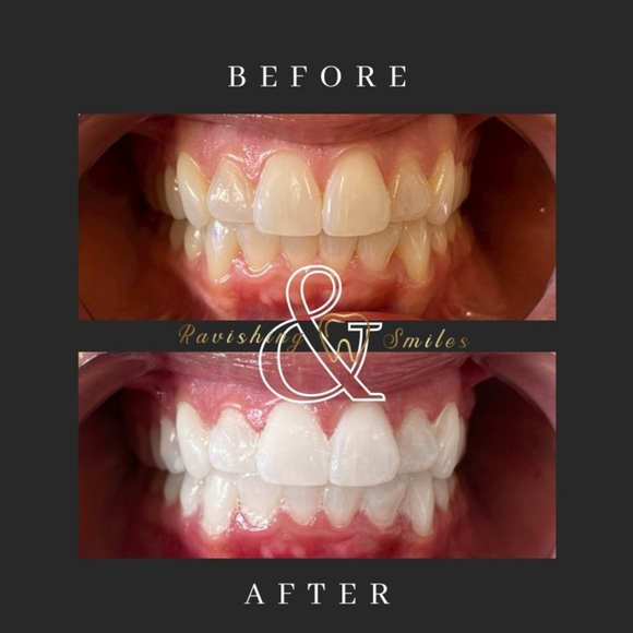 16% Hydrogen Peroxide Teeth Whitening Kit. (Unisex) - Picture 3 of 4